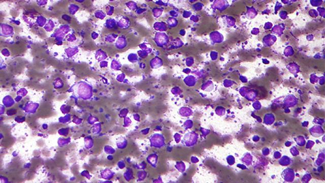 diffuse large B-cell lymphoma