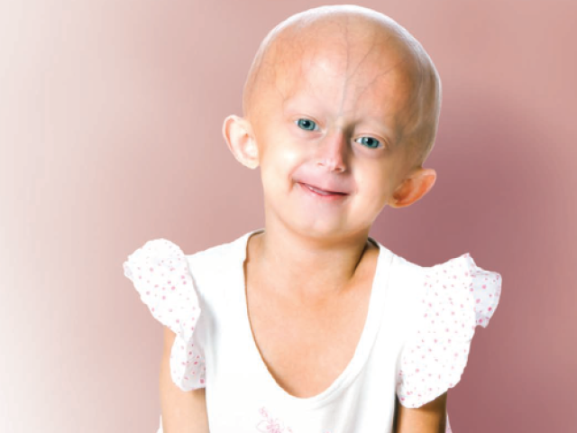 Beandri, a young girl with progeria