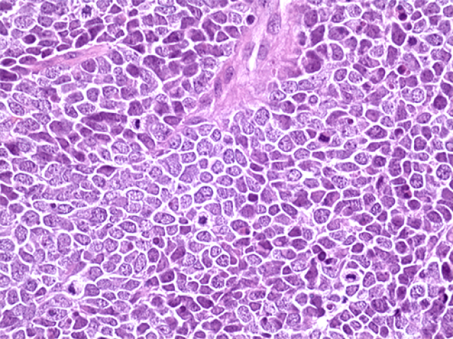 Hematoxylin and eosin staining of a tissue section from a Merkel cell carcinoma tumor.