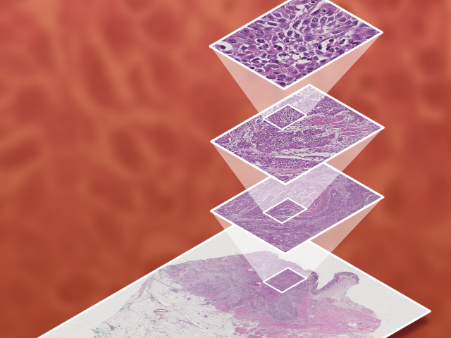 Smarter Prostate Cancer Diagnosis