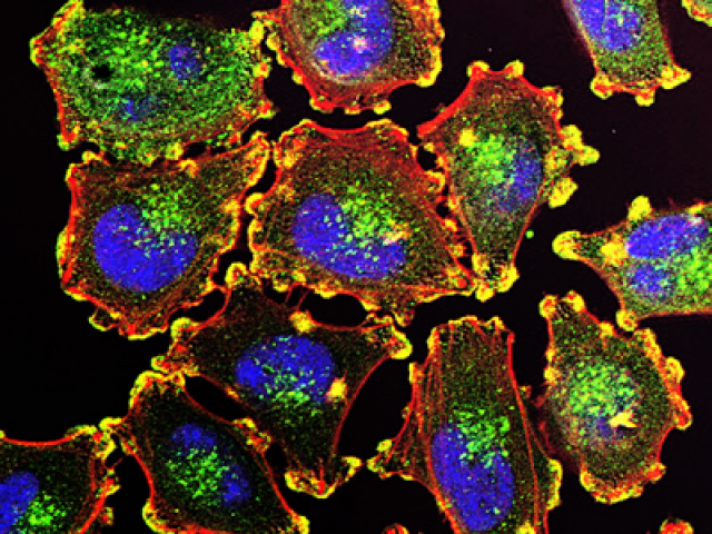 actin-rich podosomes (yellow) in melanoma cells