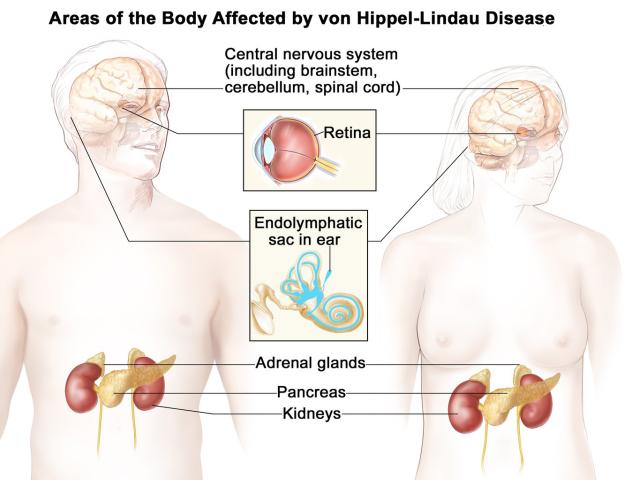 Areas of the body affected by von Hippel-Lindau (VHL) disease. Credit: NCI Visuals