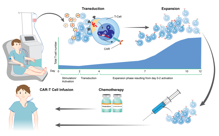 Illustration showing how CAR-T cell infusion therapy works in a patient