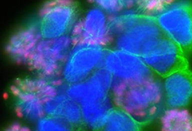 Patient-derived glioma stem cells treated with a PLK1 (serine/threonine-protein kinase) inhibitor and stained for nuclei (blue), alpha-tubulin (green), phospho-histone H3 (red).