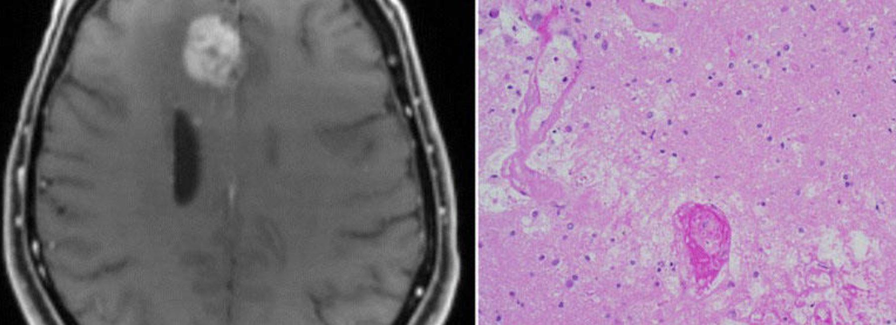 MRI scan and histology example of "pseudoprogression": imaging suggested a patient with glioblastoma had a growing tumor after treatment, but tumor sample analysis indicated the treatment did kill most of the tumor.