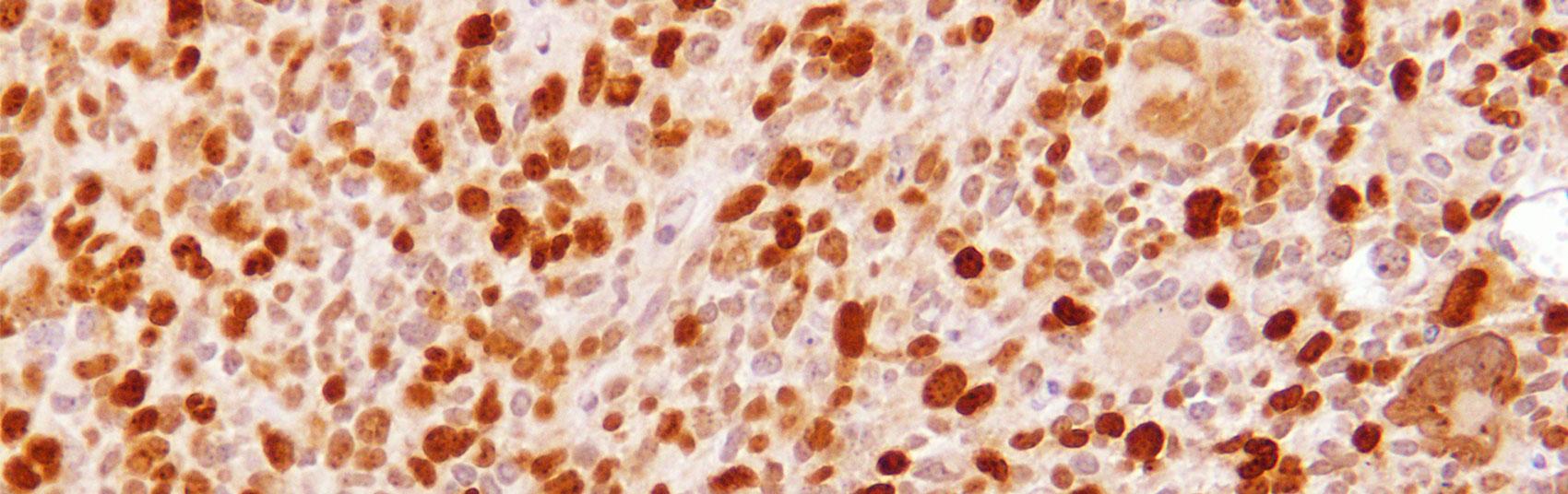 Microscopy image of glioma cells from the researchers’ preclinical mouse model