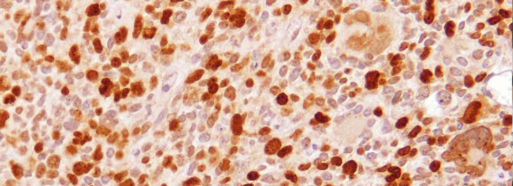 Microscopy image of glioma cells from the researchers’ preclinical mouse model.