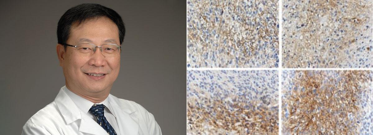 Headshot of Dr. Zhuang next to a microscopy image of glioblastoma cells