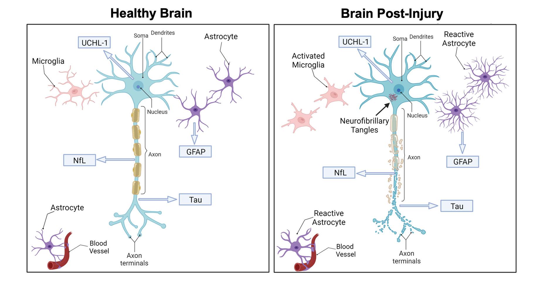 Study figure showing two side-by-side panels: one that shows a brain cell from a healthy brain and one that shows a brain cell post-injury. The post-injury cell contains proteins such as neurofilament light chain (NfL), tau, and glial fibrillary acidic protein (GFAP) that are linked to neurodegenerative changes and astrocyte activation.