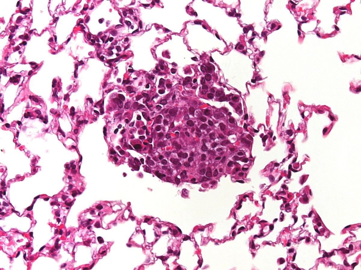 Lung metastasis in HGF;CDK4 melanoma model