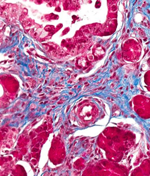 Desmoplasia in adenocarcinoma