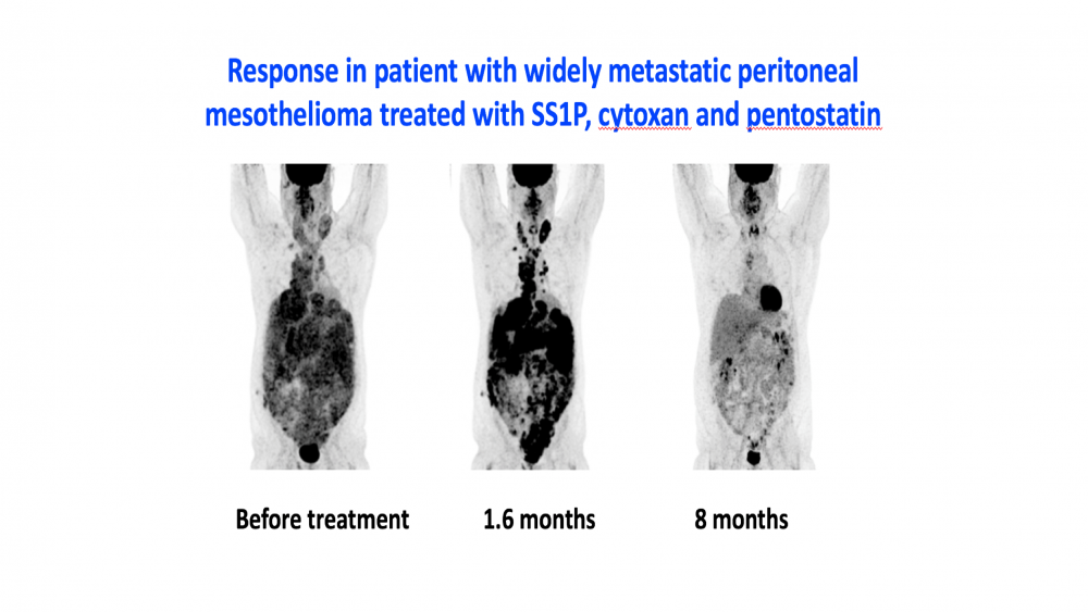 Metastatic peritoneal mesothelioma patients treated with SS1P, cytoxan and pentostatin