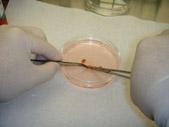 Picture 2 - Using surgical scissors to break up the tumor 