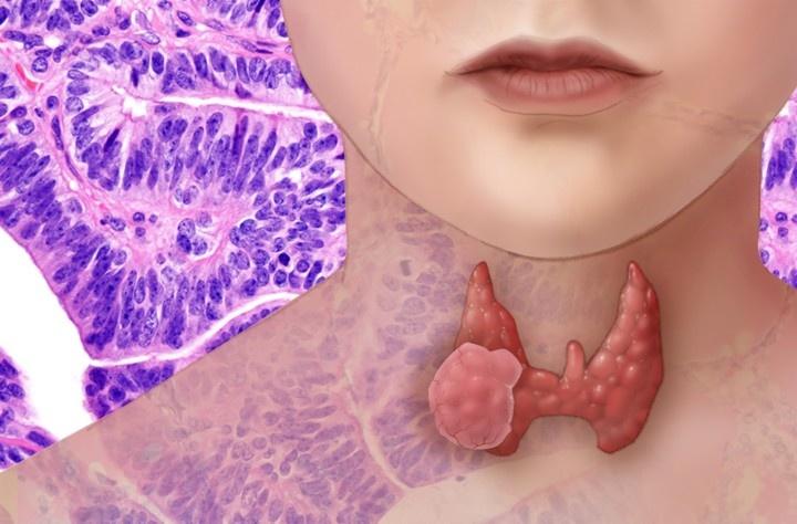 illlustration of thyroid gland with cancer