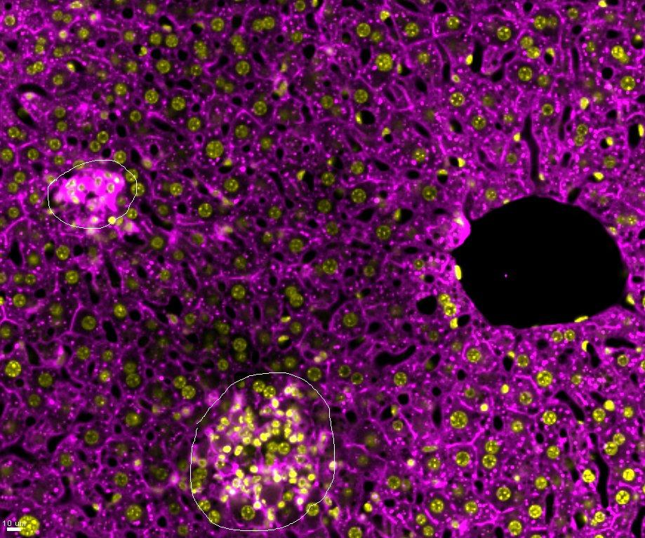 Microscopic primary liver tumors as seen in a fixed section using a confocal microscopy. Nuclei (yellow), Actin (magenta)