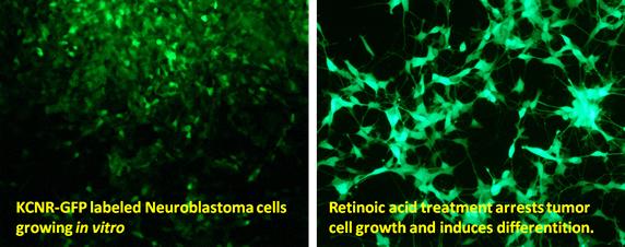 Panel 1: KNCR-GFP labeled neuroblastoma cells growing in vitro. Panel 2: Retinoic acid treatment arrest tumor cell growth and induces differentiation