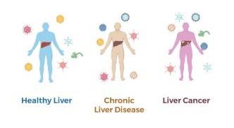 Cartoon depicting a person with a healthy liver, with chronic liver disease, and with liver cancer