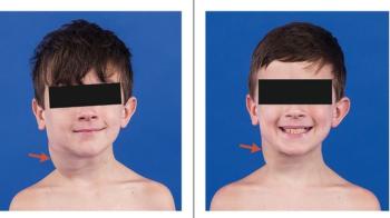 A 10-year-old patient enrolled on the SPRINT study before receiving treatment with selumetinib (left) and after receiving 12 cycles of treatment (right)