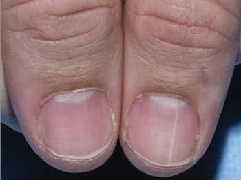 Onychopapilloma