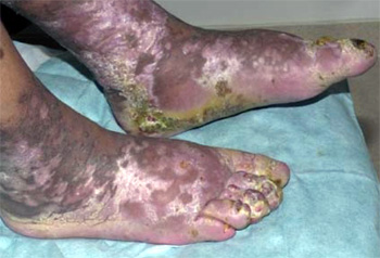 is tanner gay from Jaxson gay men associated kaposis sarcoma
